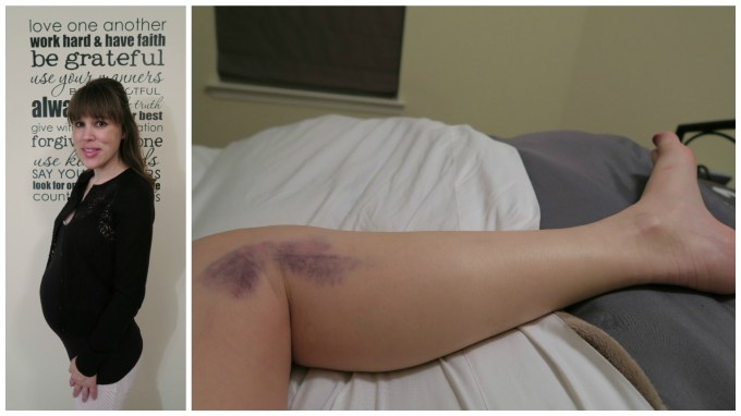 Dear Holly: Mommy’s Big Bruise a Week before Your Due Date